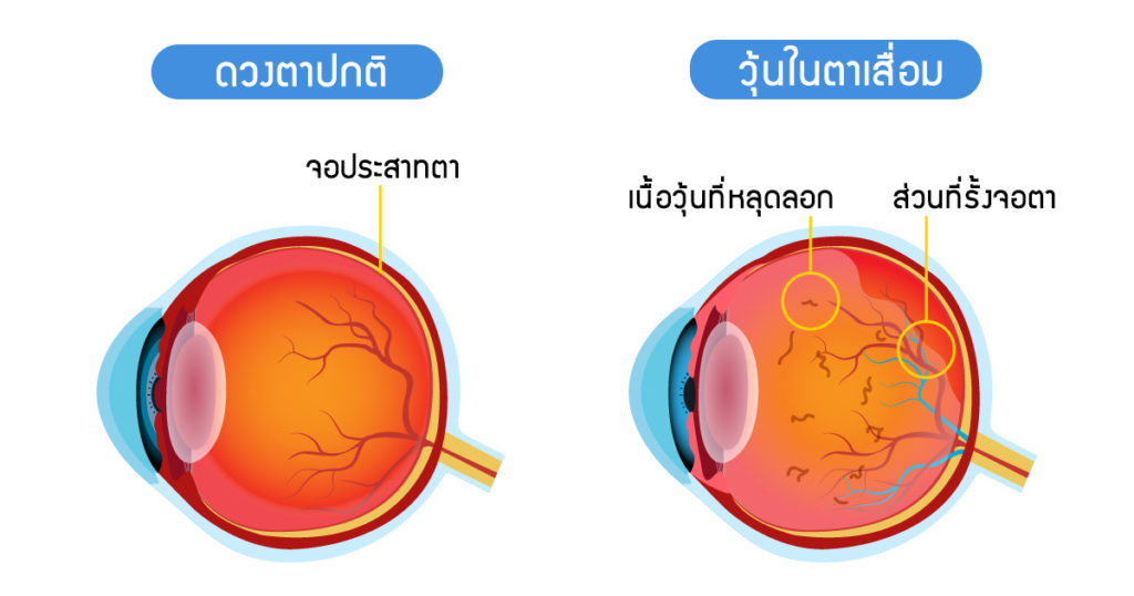 วุ้นตาเสื่อม