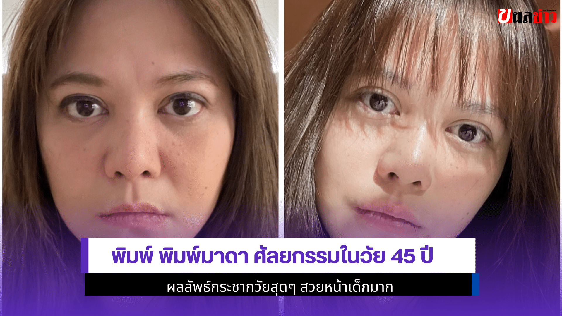 พิมพ์ พิมพ์มาดาศัลยกรรม